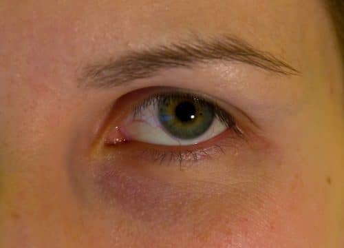 blefaroplastika