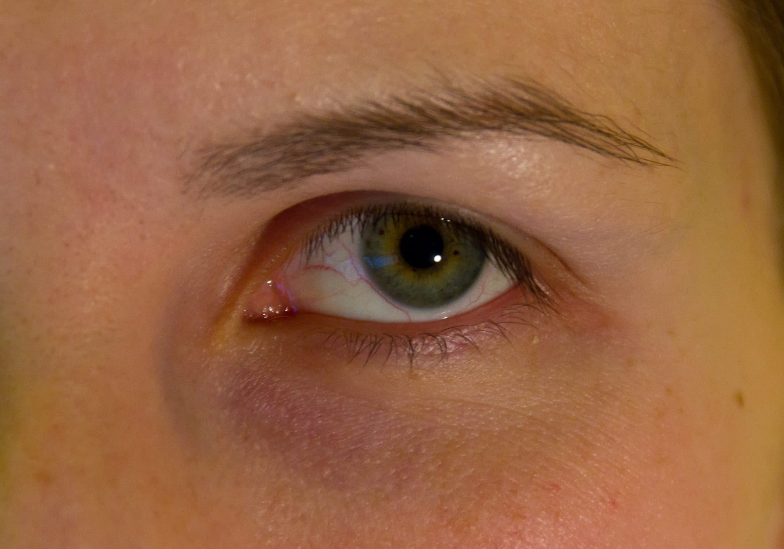 blefaroplastika