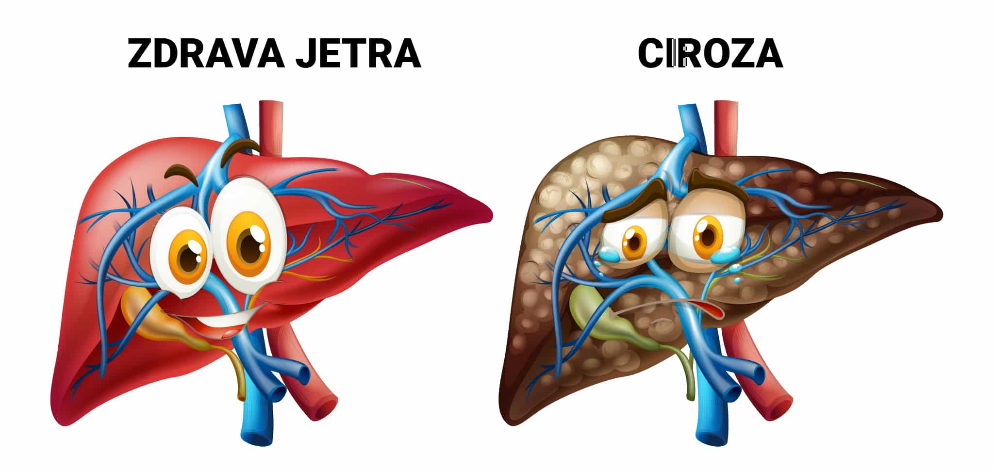 Masna Jetra i Ciroza