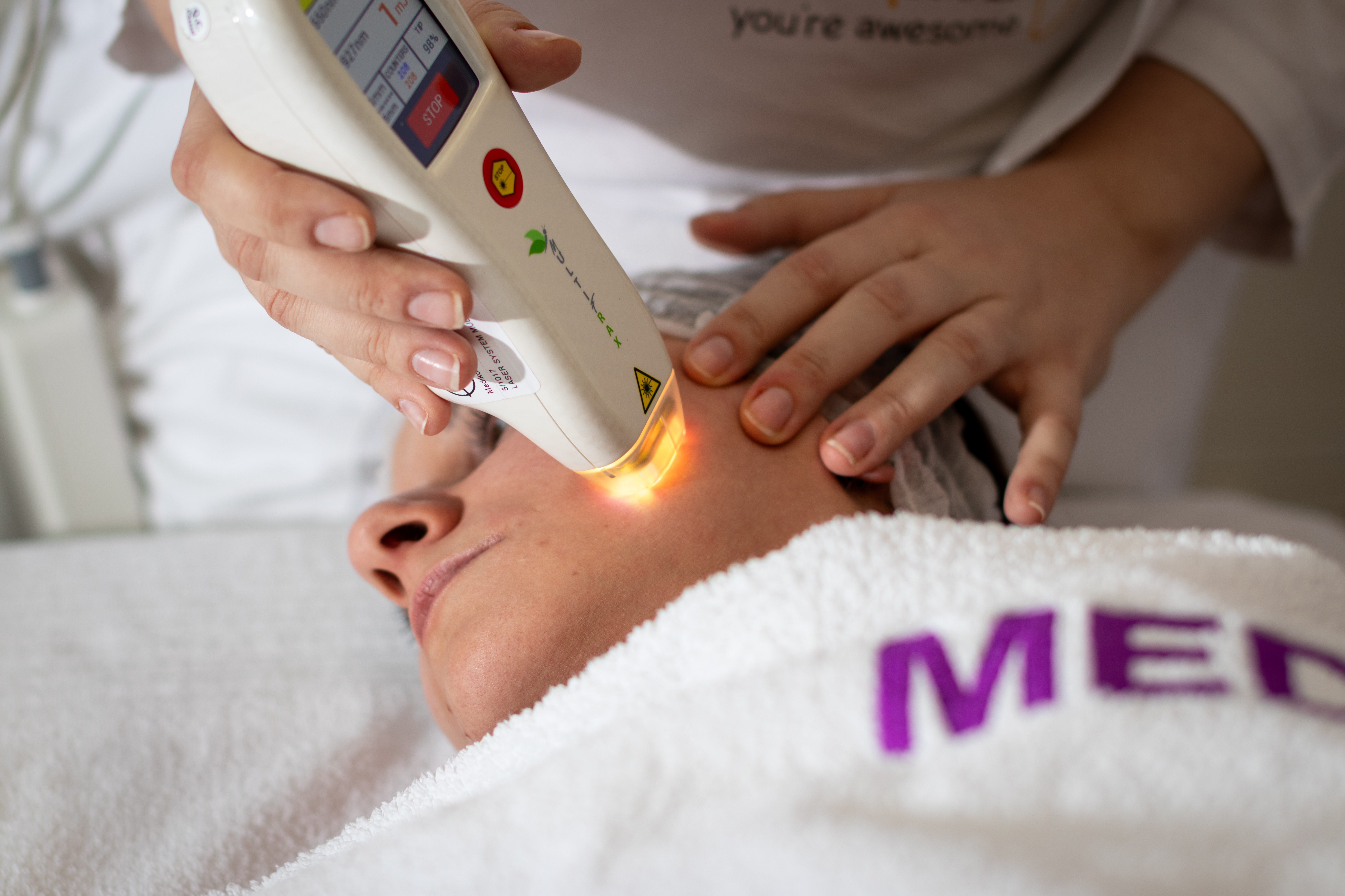 MultiFrax laser za pomlađivanje kože